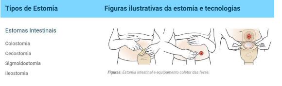 Tipos de estomia